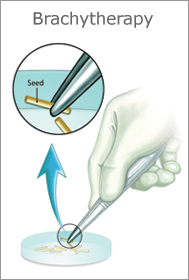 conditions_prostateCancer_brachytherapy (1)